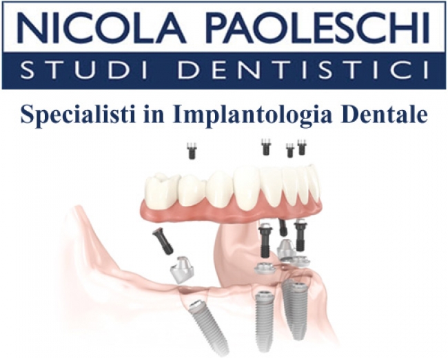 Implantologia Dentale Dr. NICOLA PAOLESCHI