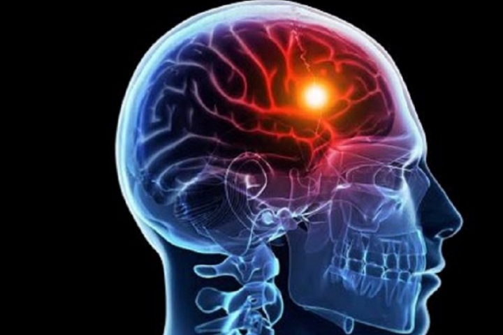 29 Ottobre: la giornata mondiale contro l’ictus cerebrale